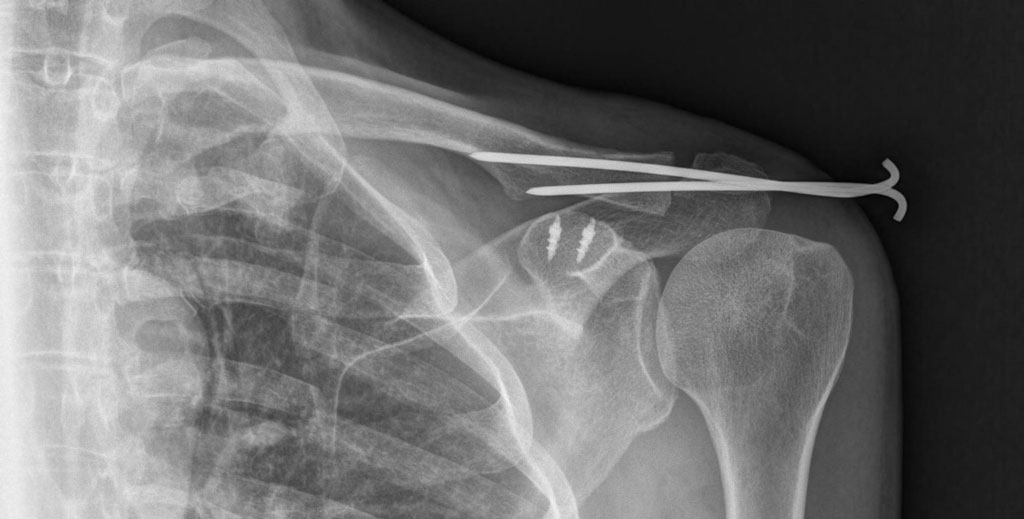 Radiografia do ombro após acidente de moto e cirurgia